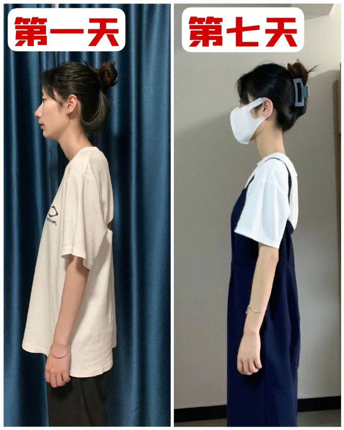 试过了！这个动作真的可以改善脖子前倾👍 ​​​
