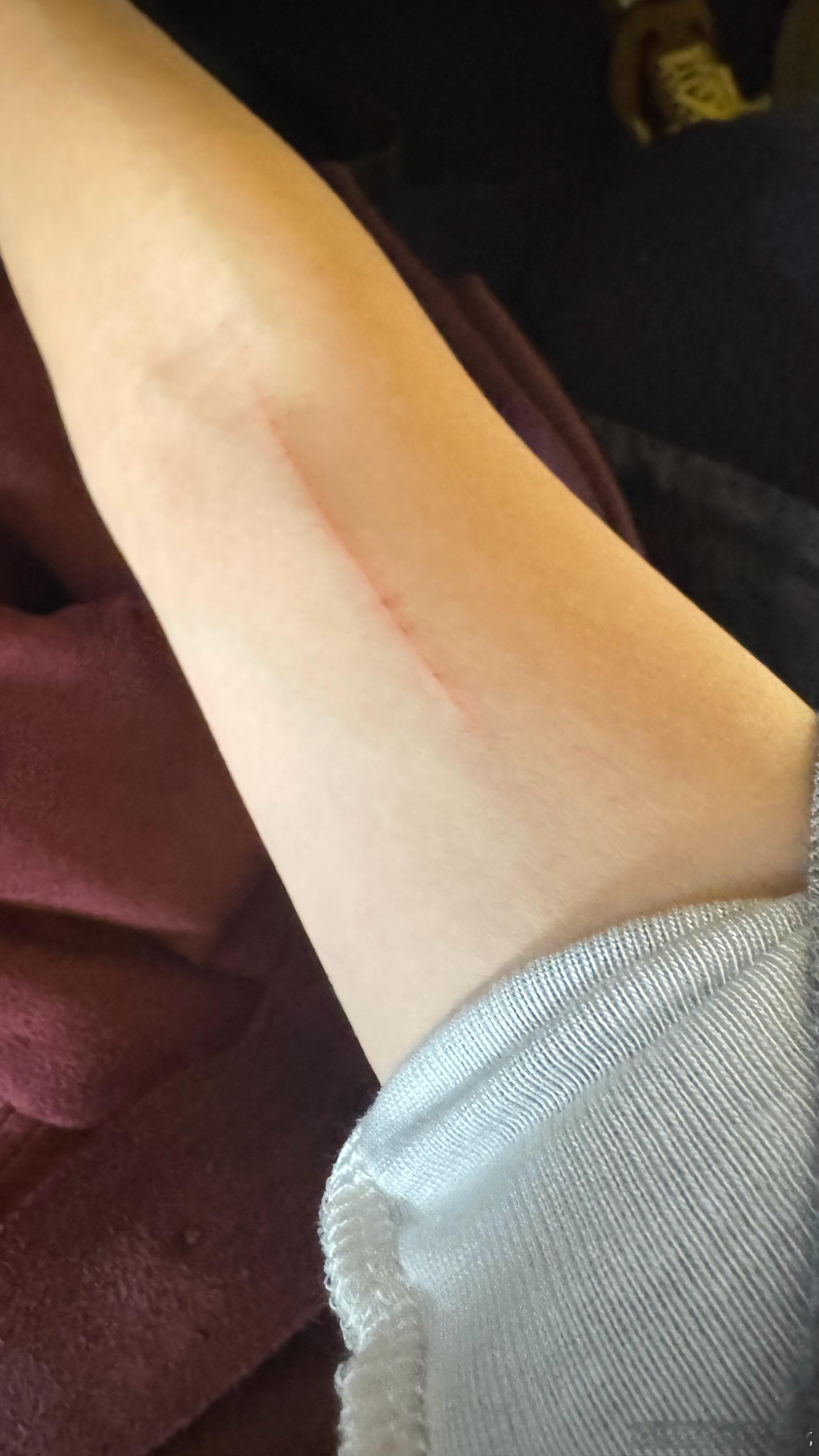 受了点小大伤，不知道咋整的