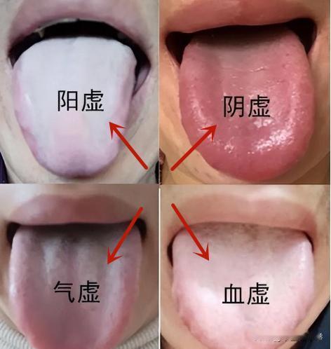 气虚生湿、血虚生风、阳虚生寒、阴虚生火，中医一举摆平四大虚
气虚生湿
原理：水液