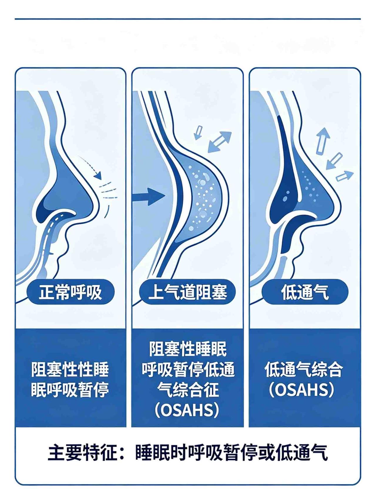 打呼噜和鼾声大有什么区别?
你家里有没有这样的场景——老伴半夜鼾声如雷，你推他一