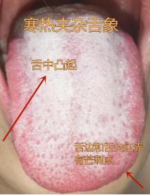 又是一个寒热错杂的舌头，最近这种舌头真的很多，最容易调错的舌头。
 
气温回暖，
