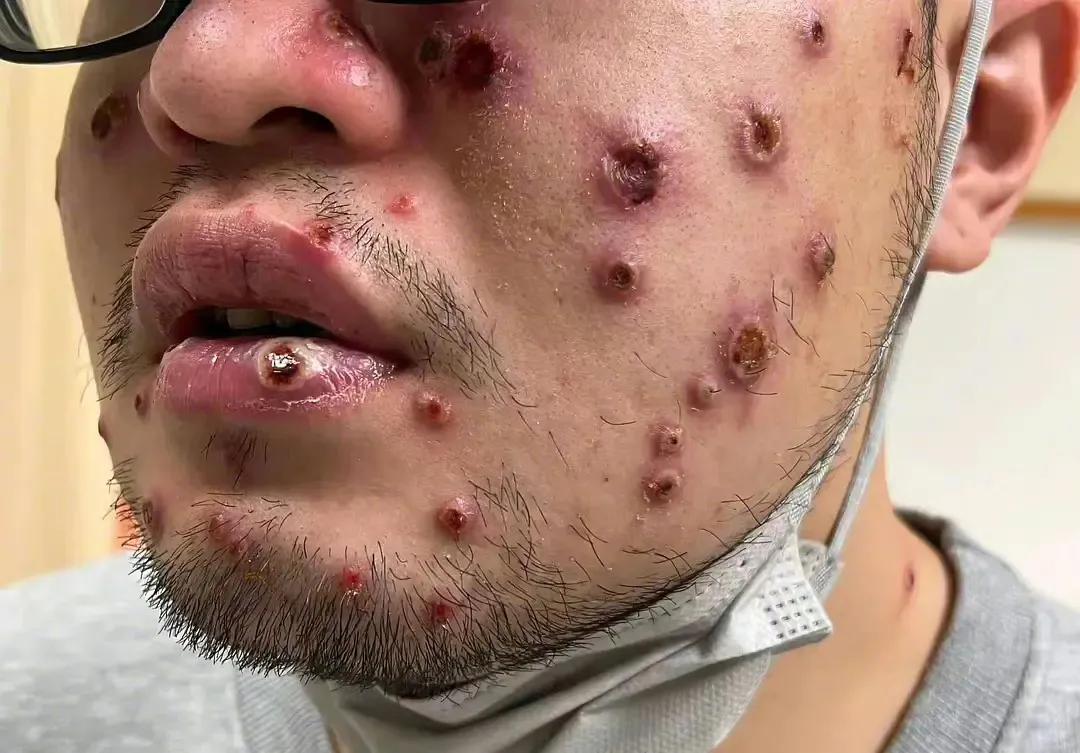 全国猴痘病例已达52例，会留疤毁容，如何预防
二阳还没有远离，猴痘又出来让人心烦