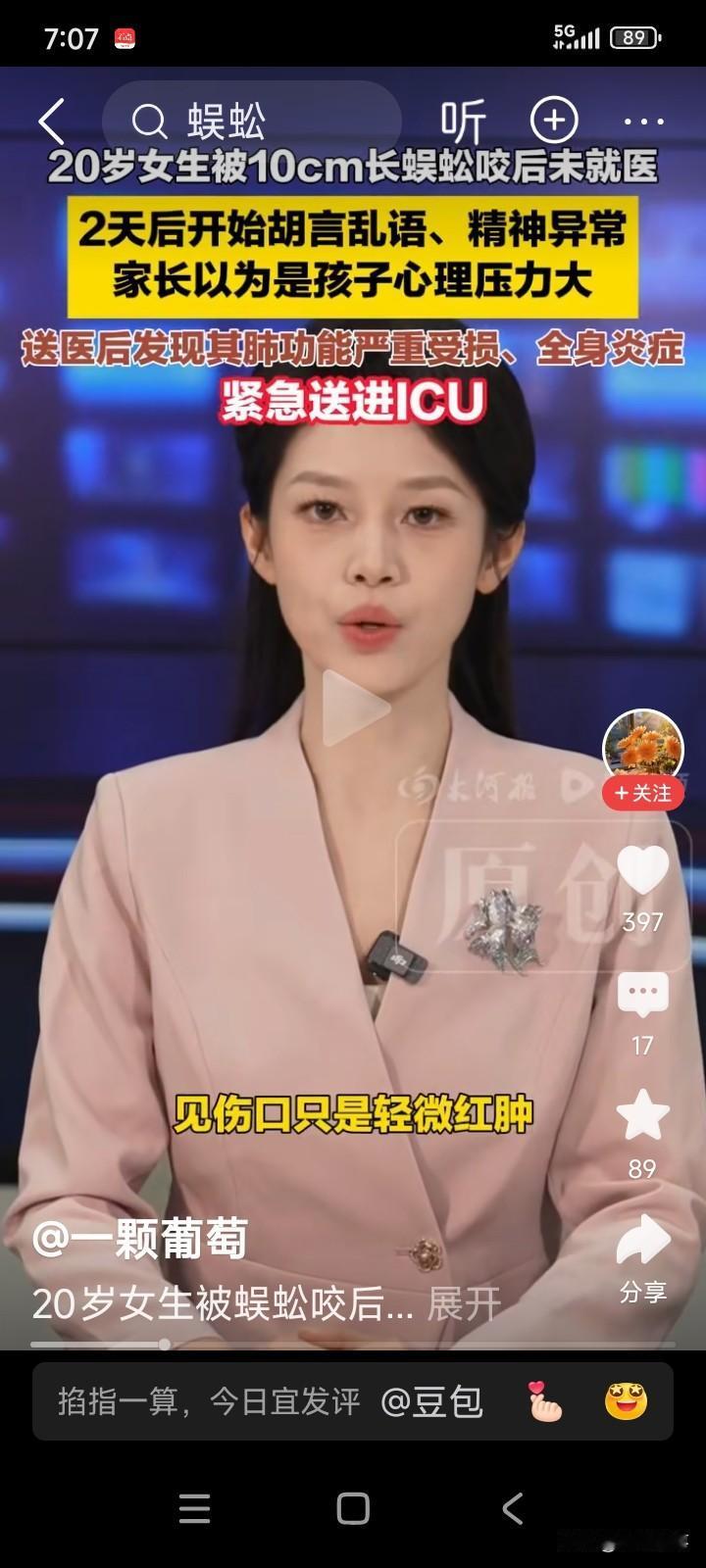 一位20岁的女孩，玩耍时不慎被蜈蚣咬伤。
当时女孩并未感到任何不适，便没把这事放