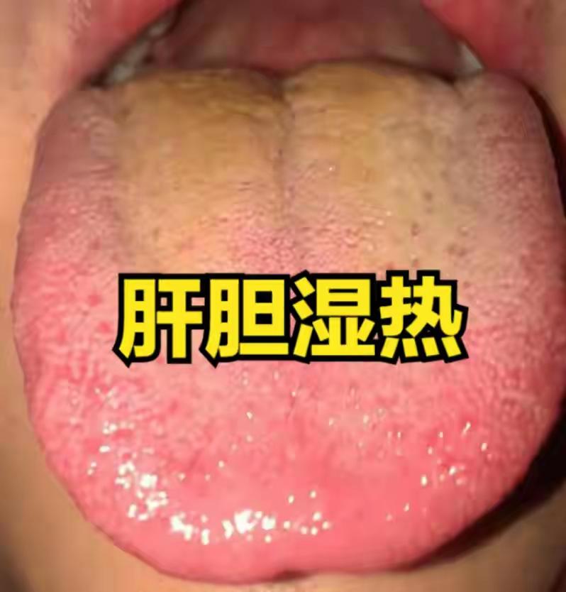 三妙汤+龙胆泻肝汤加减：专攻肝胆湿热，疏肝泻火、导湿下行
大家好，我是陈大夫。