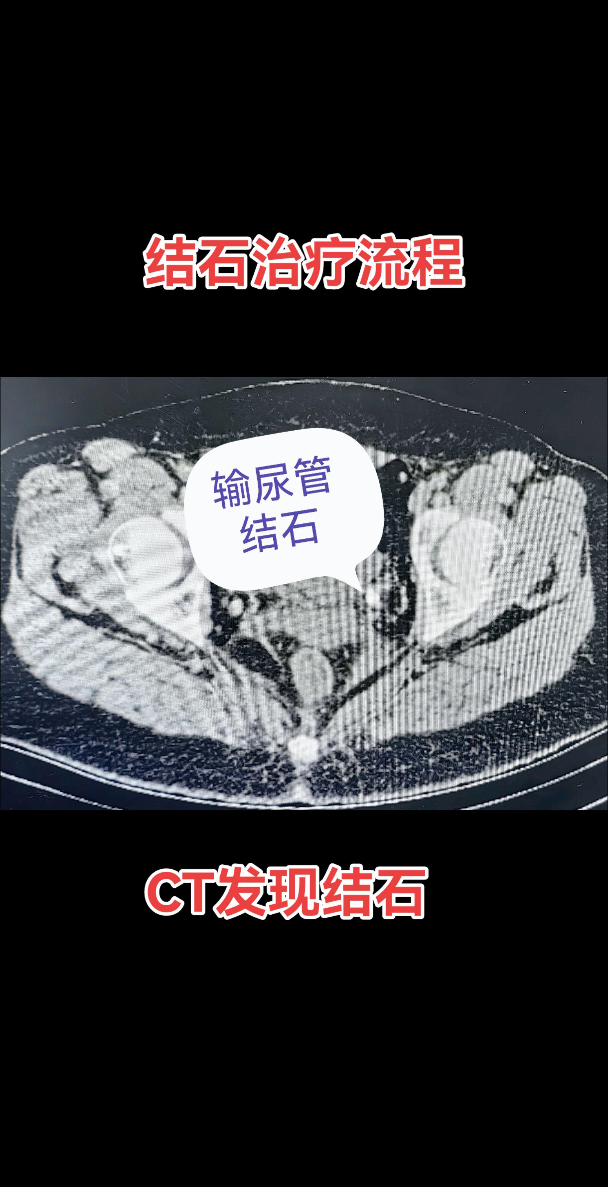 结石治疗流程