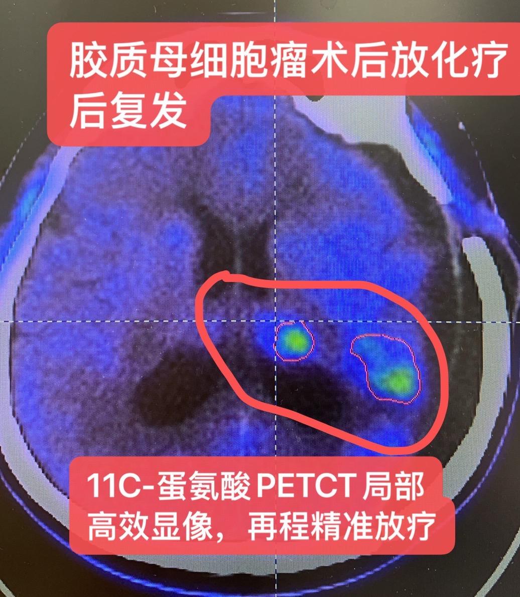 胶质母细胞瘤术后放化疗后：复发怎么治疗？根据新的11C-蛋氨酸PETC...