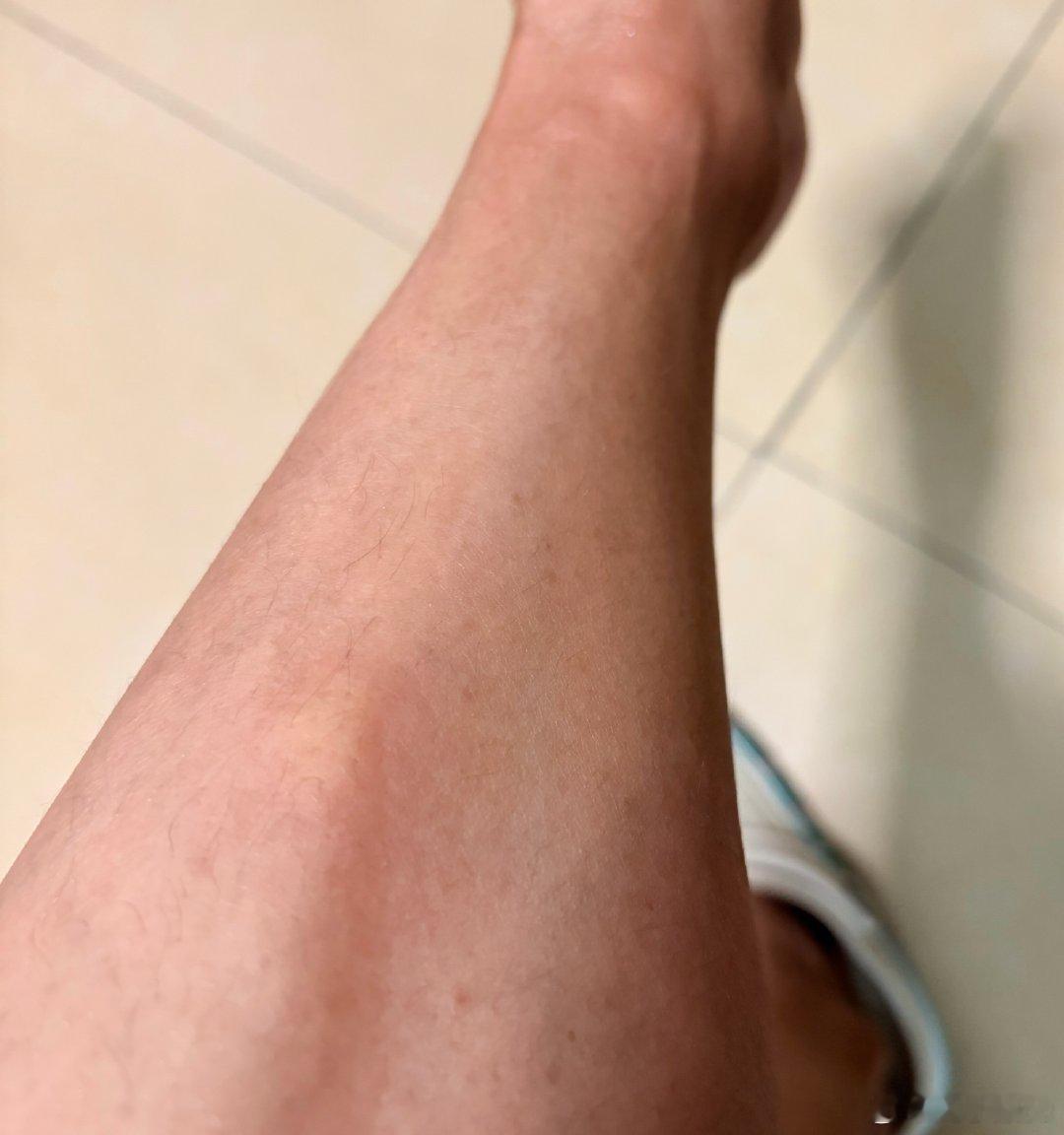 下楼去买吃的，我带娃在楼下等宝爸去买，几分钟的时间就被咬成这样了，看到宝爸回来赶