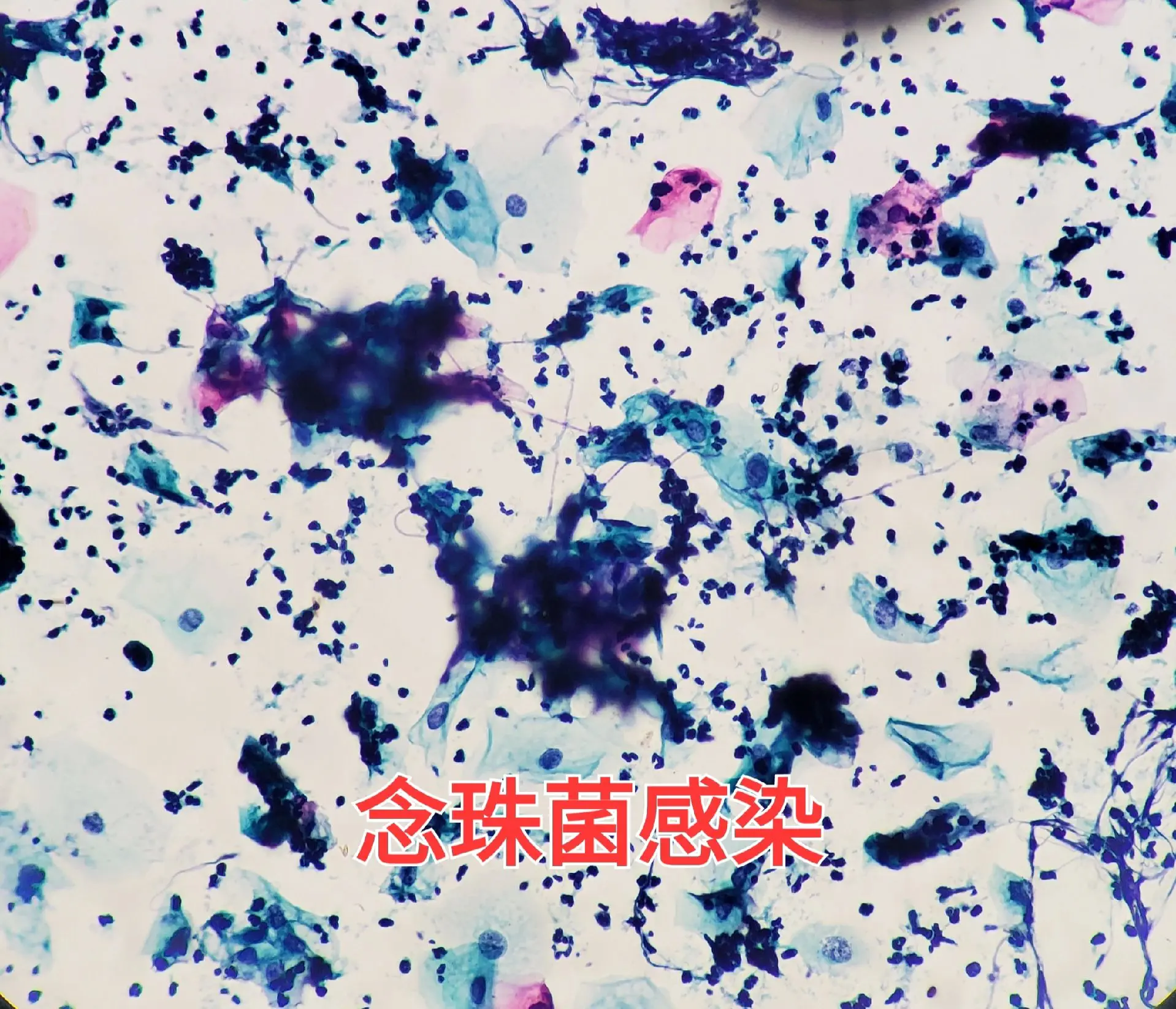 宫颈tct  念珠菌感染