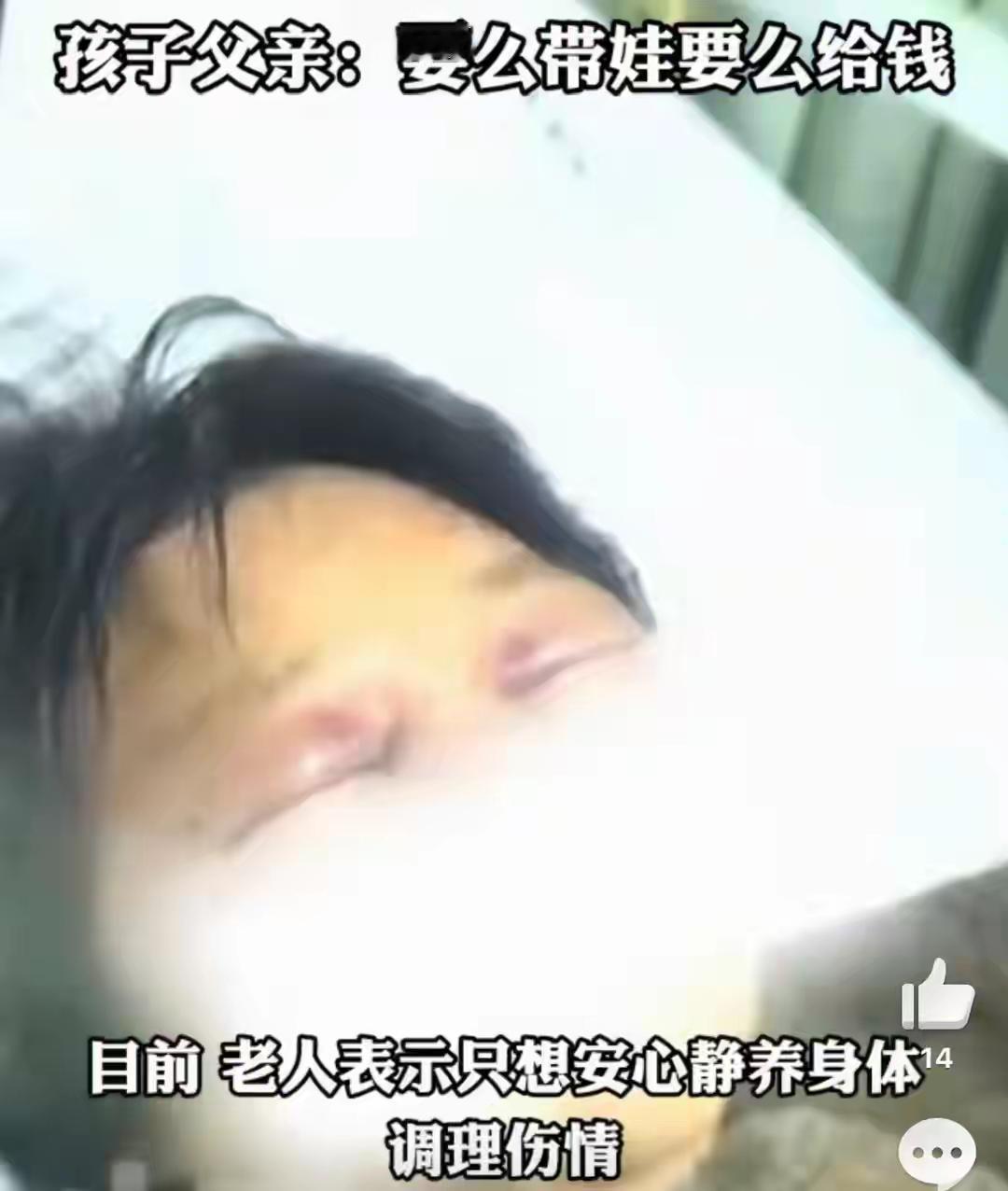 浙江嘉兴一儿媳暴打婆婆，导致婆婆四根肋骨当场被打断，双眼红 肿，伤势严重。更让人