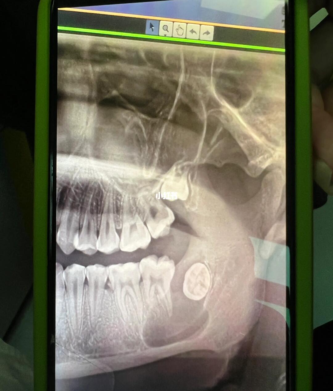 小伙颌骨囊肿手术后脸肿成🐷头！