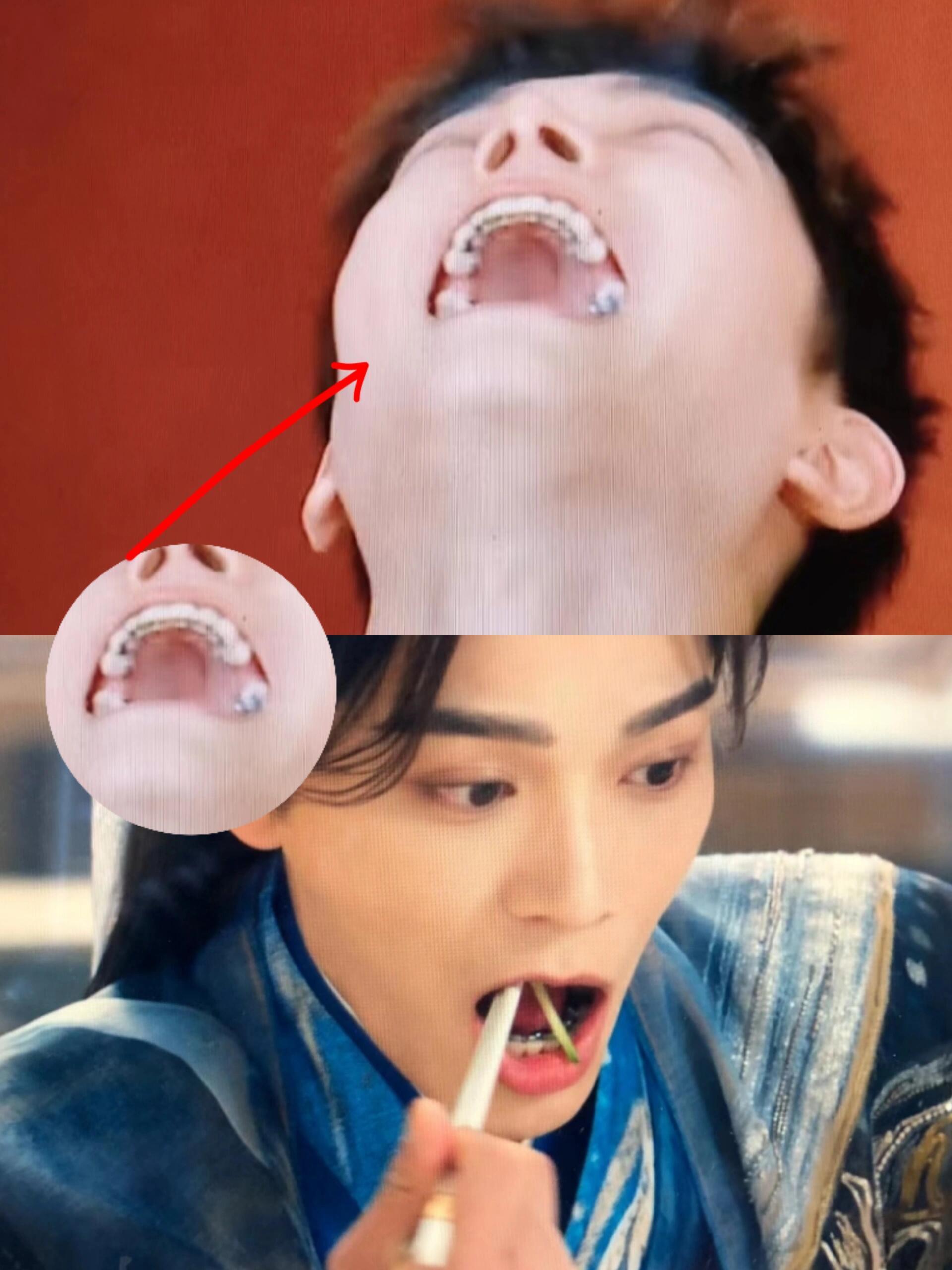 原来他不止舌侧，还拔牙矫正了…… ​​​