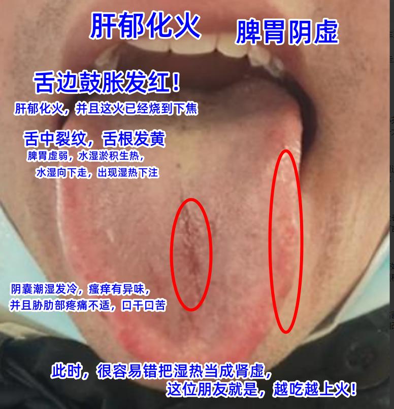 今日舌诊案例分析：寒热错杂，肝脾不通，湿热下注，心肝火旺[给力][给力][给力]