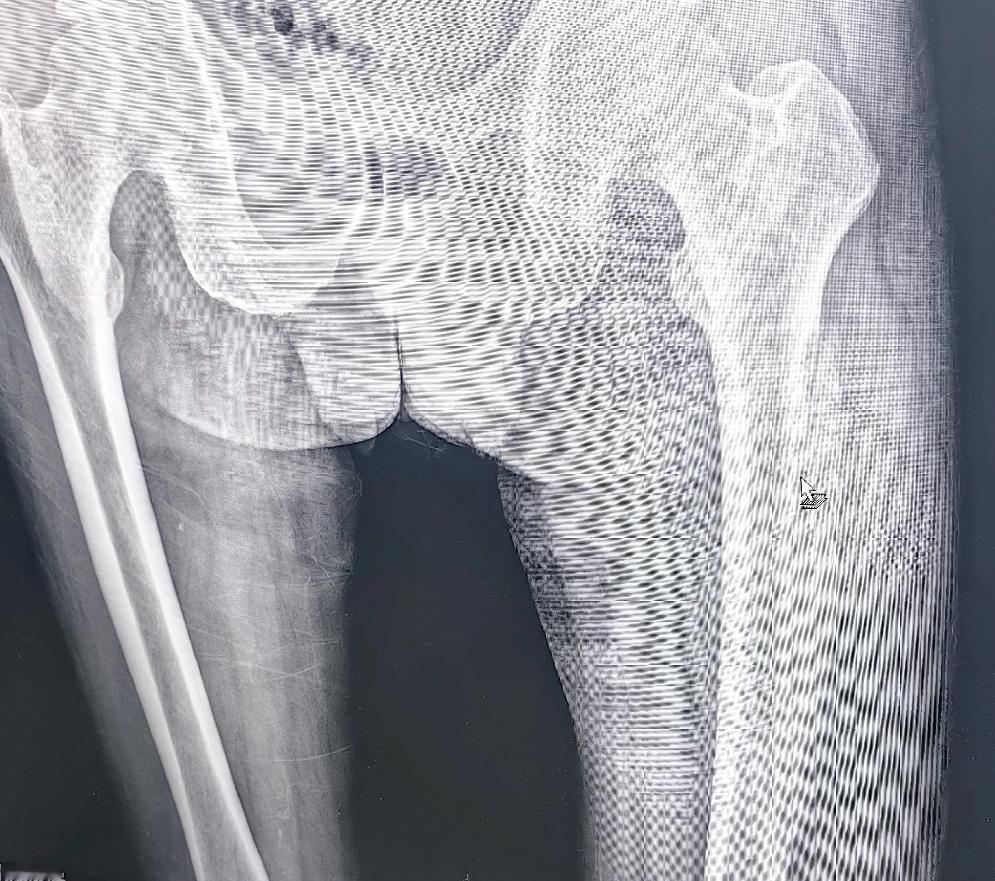 冬日生活打卡季骨髓炎哈尔滨哪治疗的好吗？