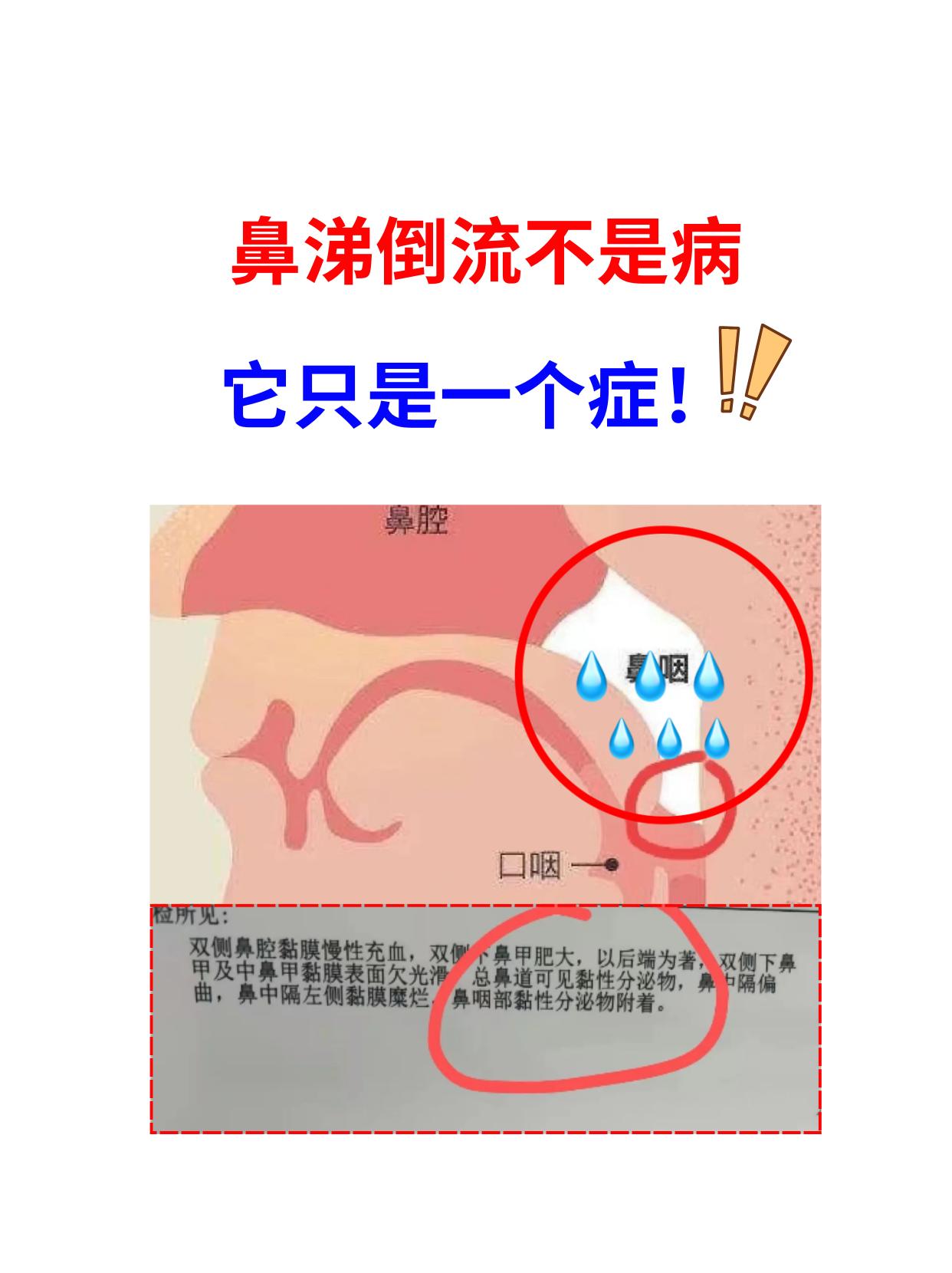 鼻涕倒流不是病，它只是一个症！
 
很多人鼻炎鼻涕倒流治不好，是因为没有搞清楚问