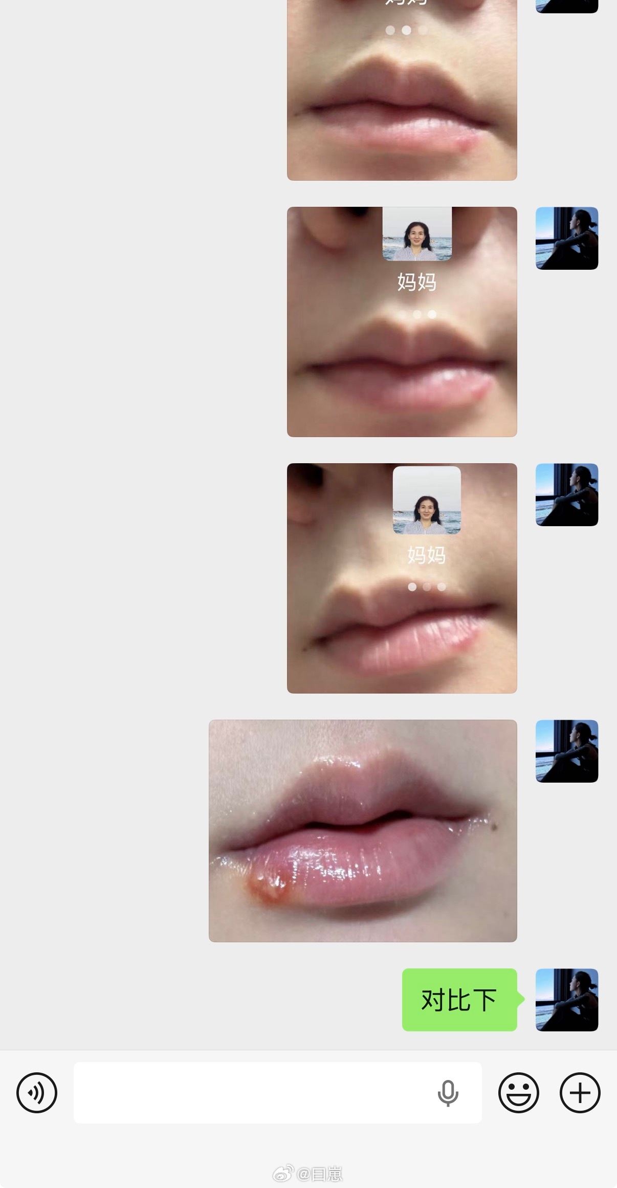 俺娘担心我的泡会留疤 哈哈哈哈哈哈哈 