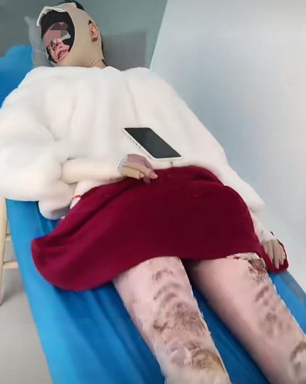 女子彻夜充电致全身70%烧伤！这个习惯你可能也有！
 
湖北一名女子因为习惯睡前