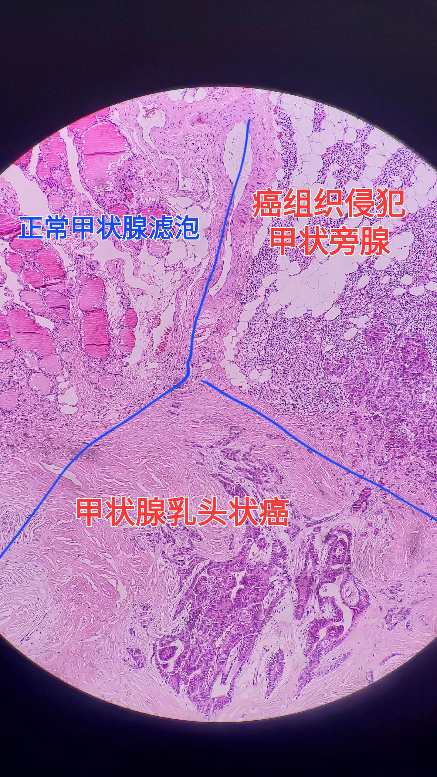 甲状腺乳头状癌 甲状旁腺