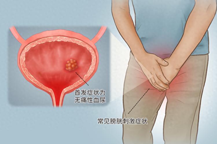 68岁男子因膀胱癌离世！提醒：小便出现这3种异常，不可疏忽大意

膀胱癌几乎不会