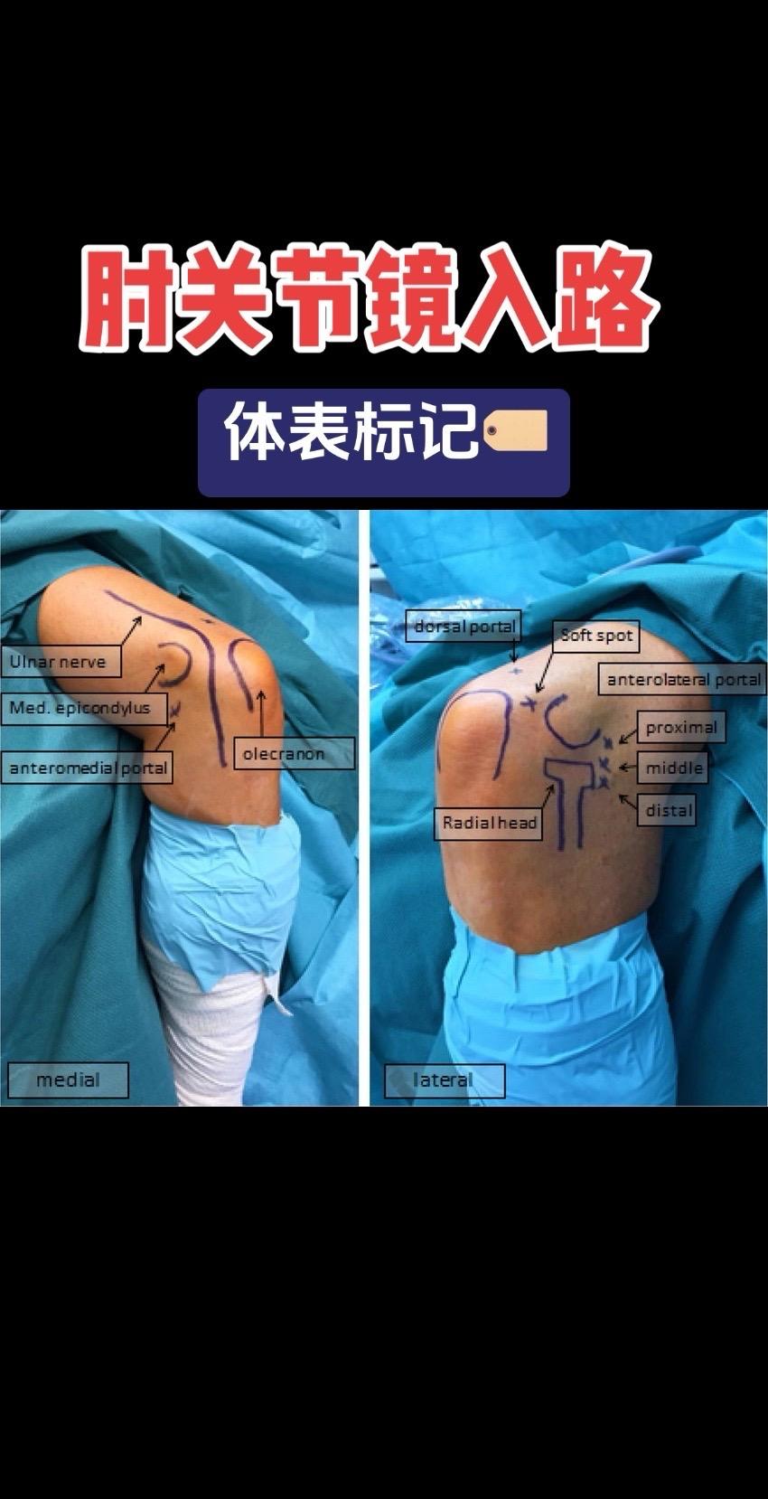 肘关节镜入路。🔍肘关节镜入路“死亡三角”？这些神经必须躲开！   一...