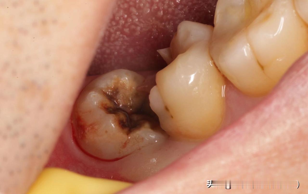 这智齿也太能熬人了！痛了大半个月，消炎针、布洛芬、甲硝唑、阿莫西林轮番上都没用，