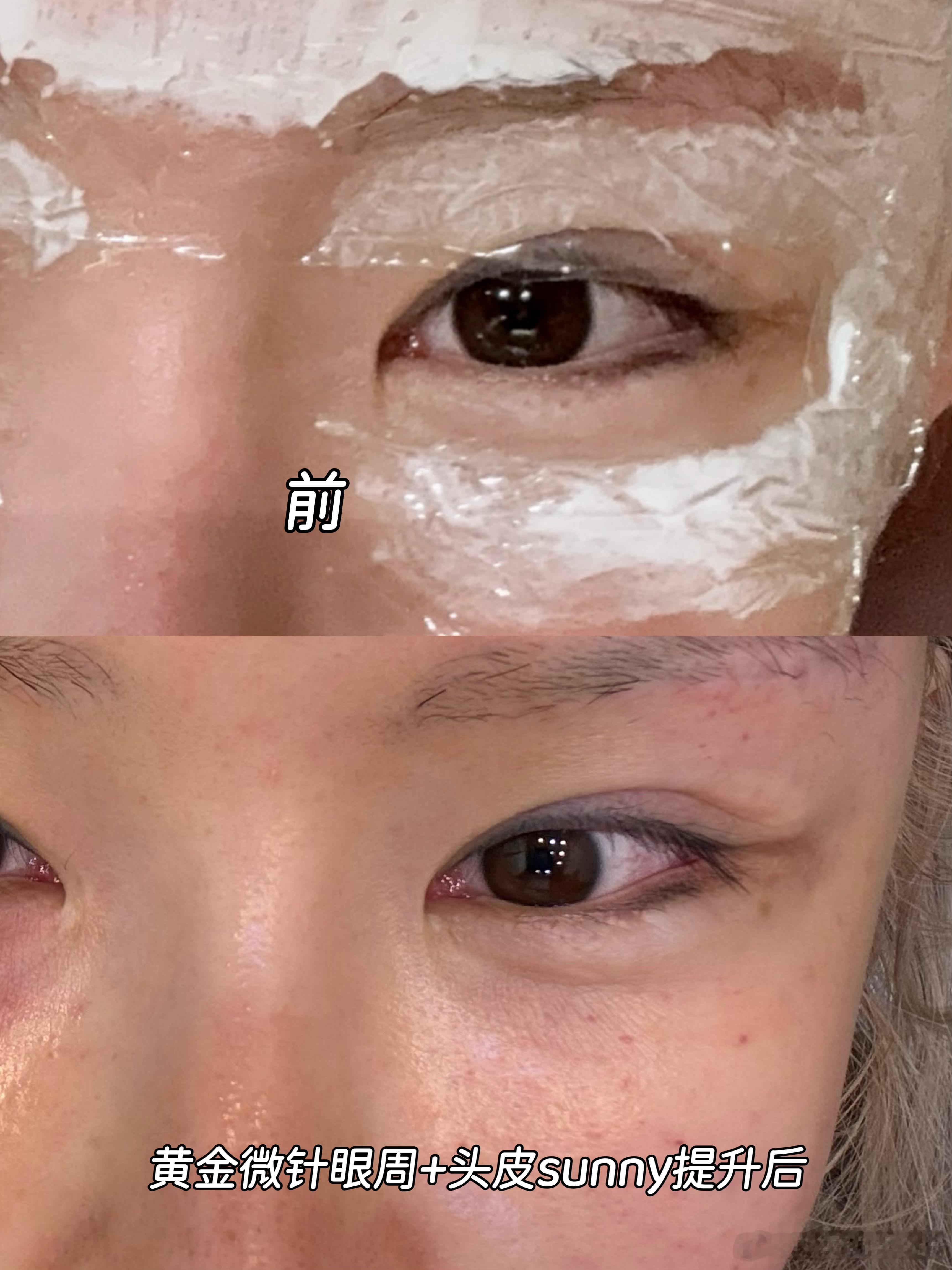 还是觉得黄金微针眼皮+头皮sunny提升这两个项目都牛！自己照镜子肯定没有那么明