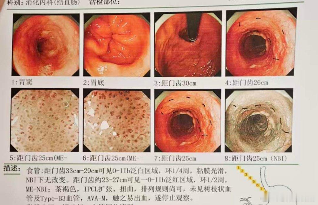 这个早癌最终病理是高级别上皮内瘤变，累及食管下腺导管，基地和切缘未见病变累及。食