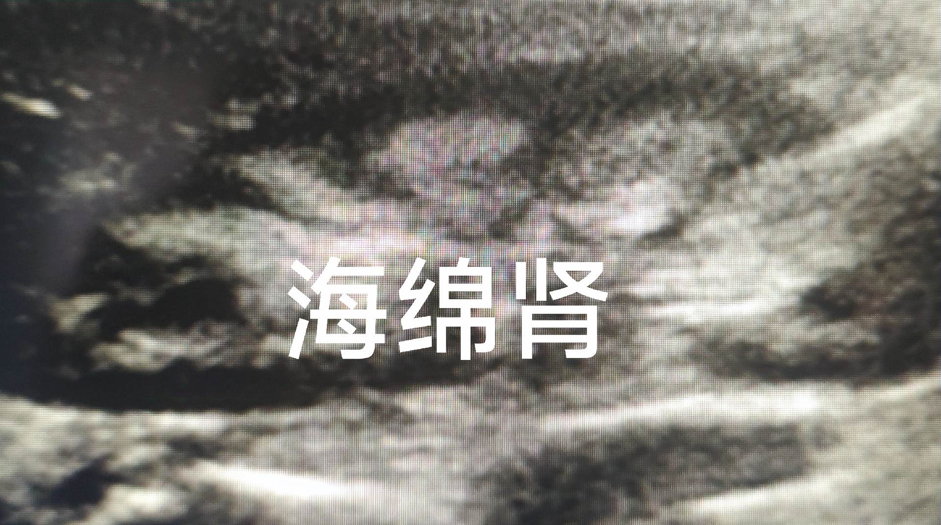 海绵肾。海绵肾与肾钙质沉积症鉴别