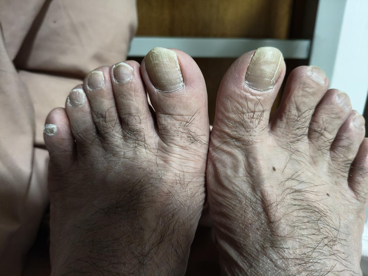 值得庆幸的一件事
         多年的灰指甲彻底治愈了
   记得来北京的前