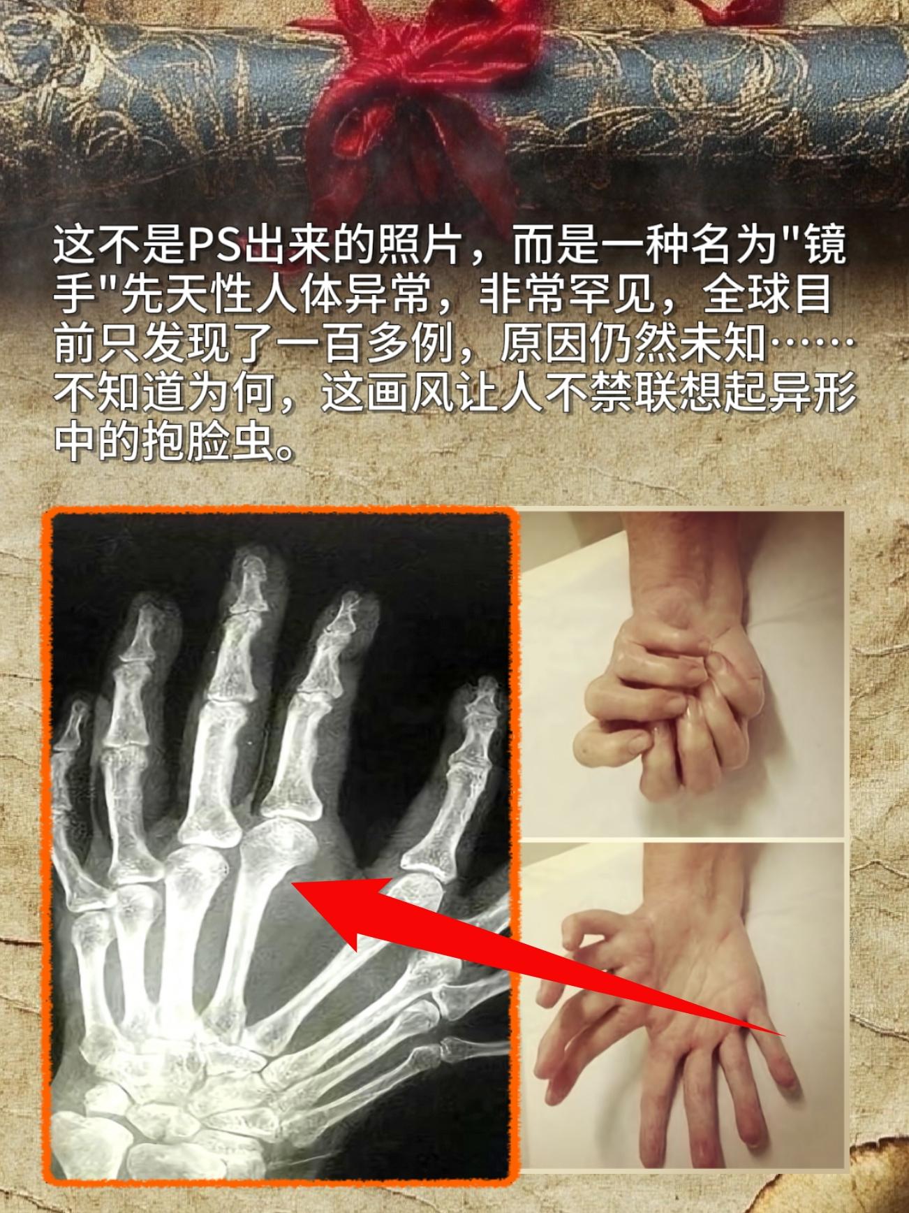 这不是PS出来的照片，而是一种名为"镜手"先天性人体异常，非常罕见，全...