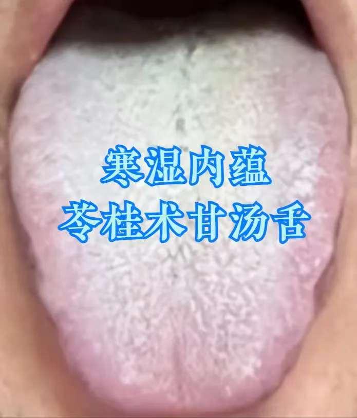 一、舌象辨证：跳出 “脾虚” 误区，认准 “肝火 + 湿热” 信号
出现消化、上