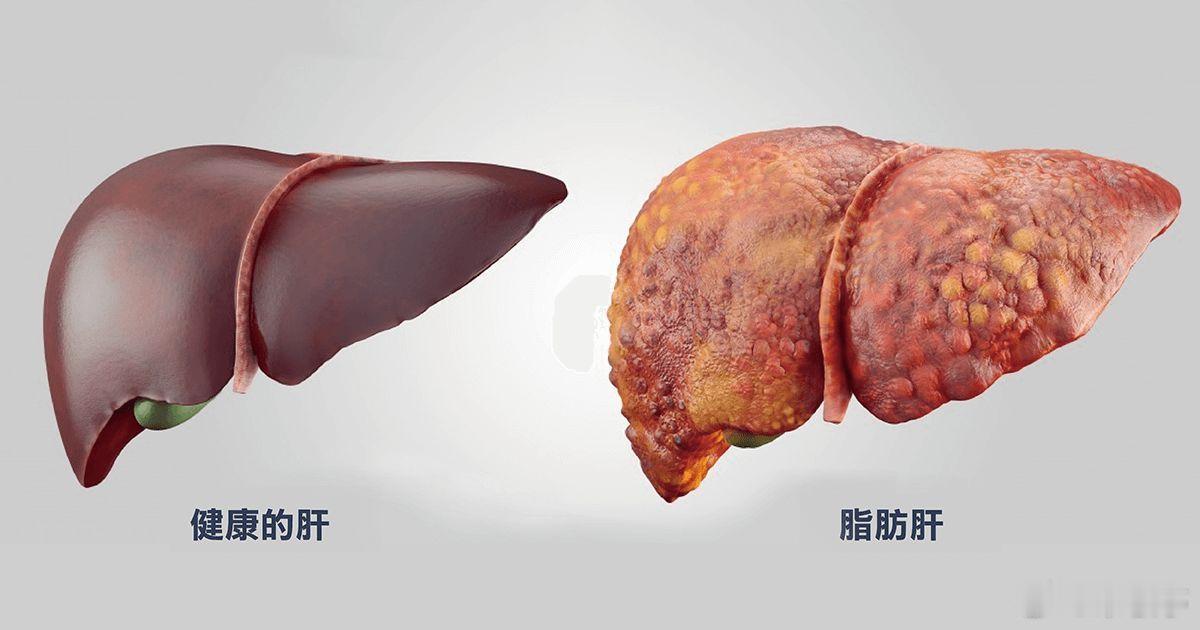 我国每3人就有1人患脂肪肝每三个人就有一个患脂肪肝，而且北京比例更高？这确实需要