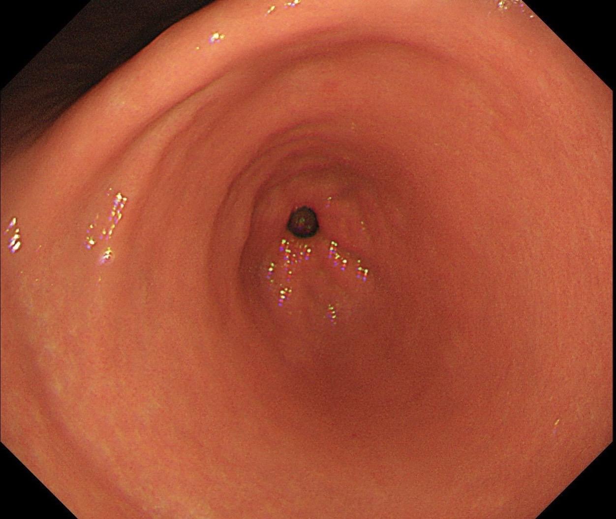 男，40岁，胃双发褪色调病变。慢性胃炎复查，3年前胃镜未见异常，Hp阳...