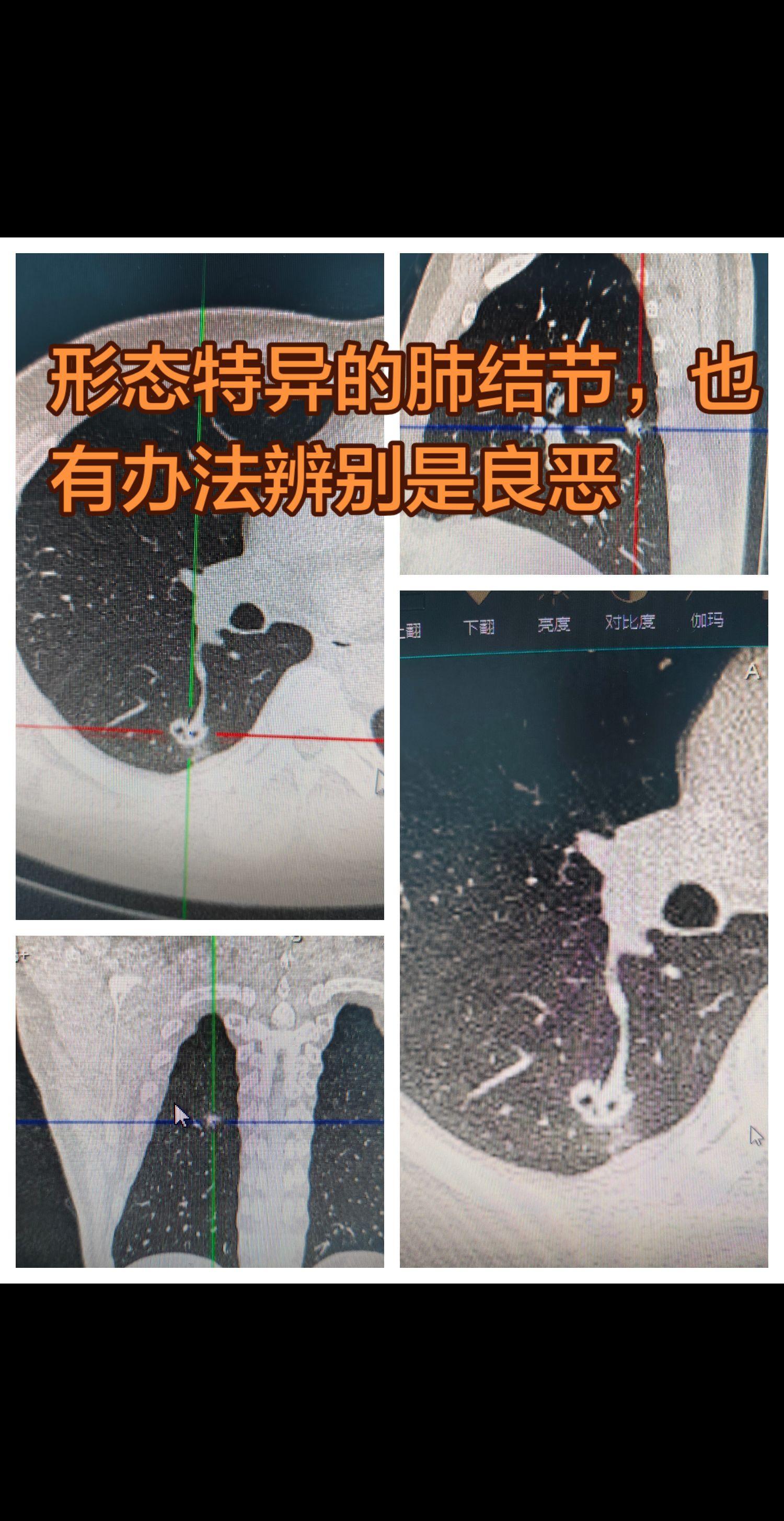 肺结节表现千形百态，纵难逃一刀除了。纵使肺结节形态不一样，也要做好评估...