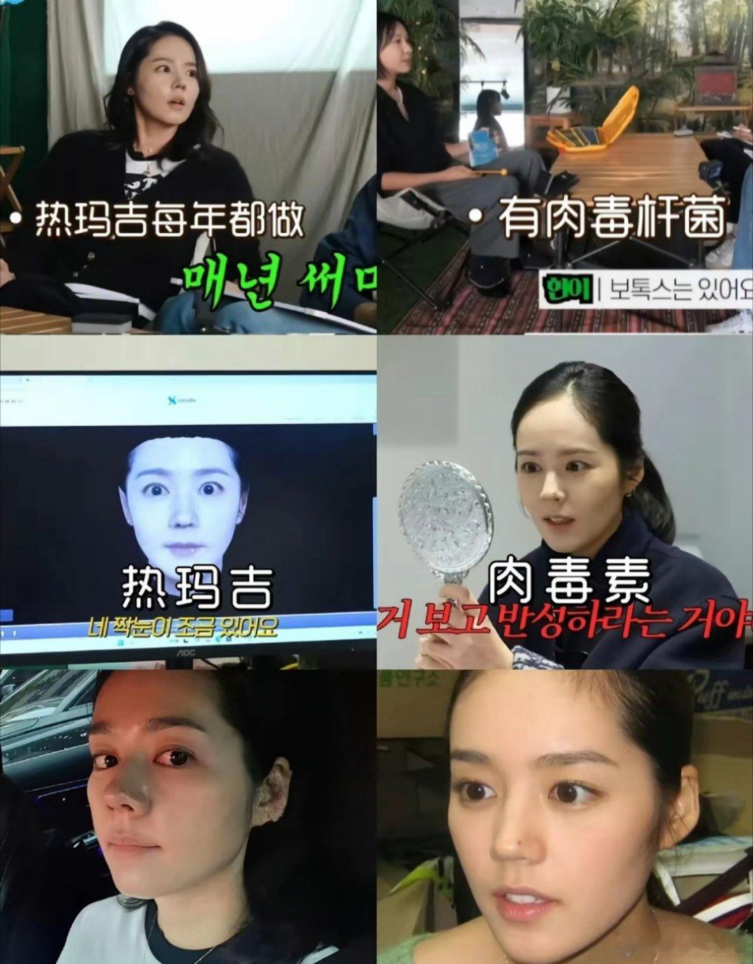 韩佳人做过的医美，但没有做过整容项目！ 