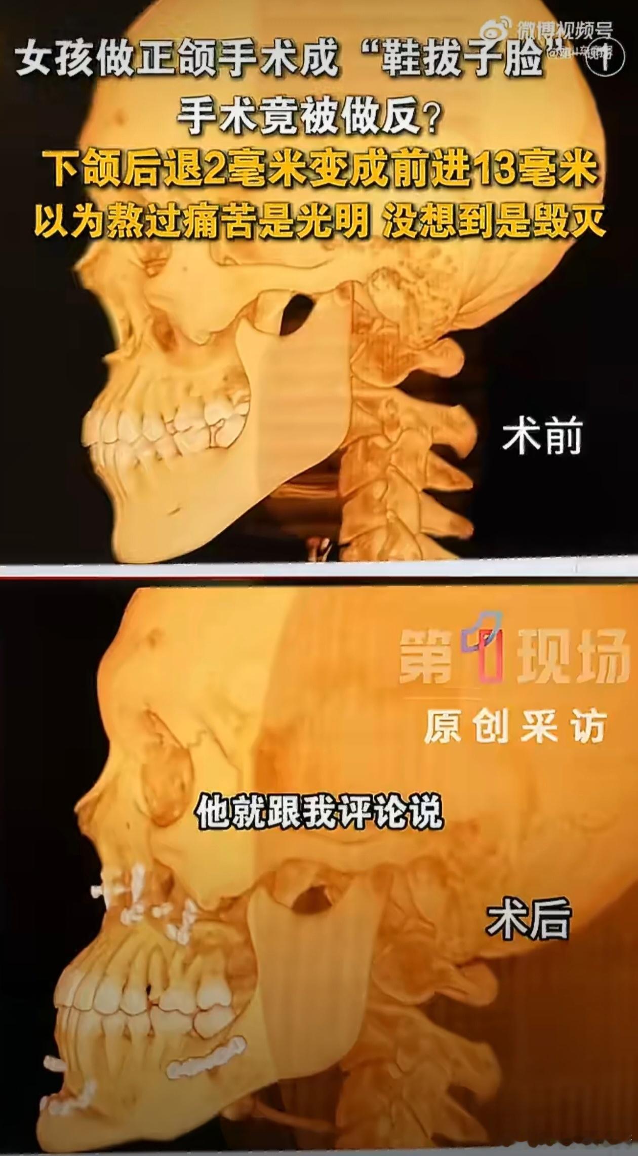 卫健委介入24岁女孩正颌手术被做反医疗事故，妥妥的姑娘对自己有点不自信了，不然也