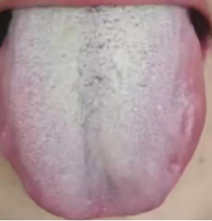 不要一看到白苔就觉得是寒气重，要温阳，简直是在胡闹！

很多人一见到舌面覆白苔，