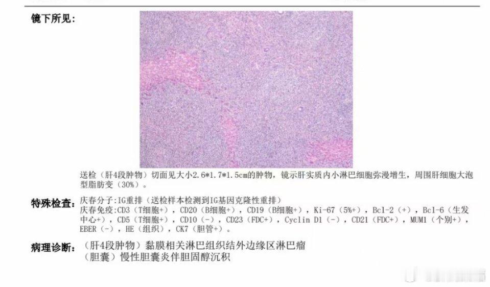 肝脏的淋巴瘤（即肿瘤起源于肝脏内的淋巴组织），也可由其他部位淋巴瘤转移至肝脏（继