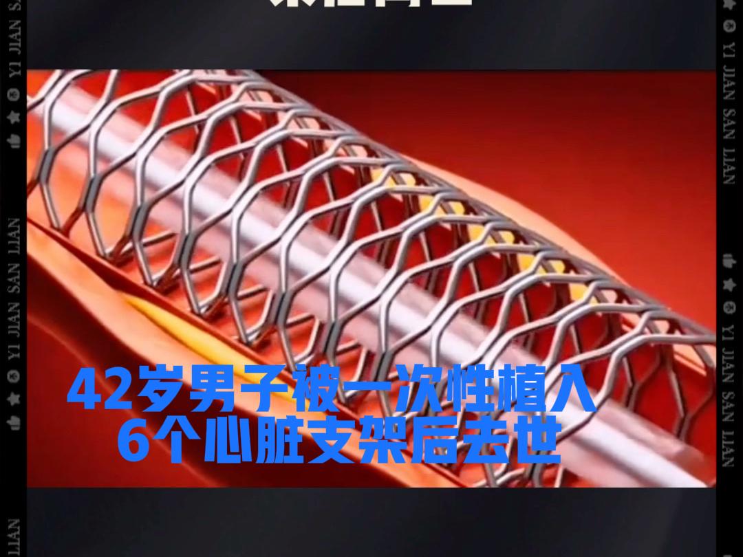 热议：42岁男子被一次性植入6个心脏支架后去世

42岁男子本无不适，被医院反复