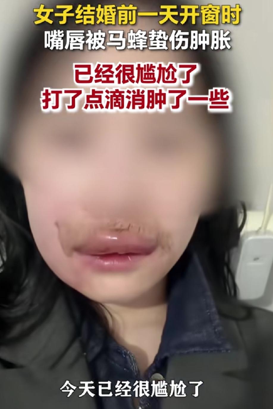 女子结婚前一天被马蜂蛰成香肠嘴
近日，四川一准新娘前一天在农村厕所洗漱完，准备收