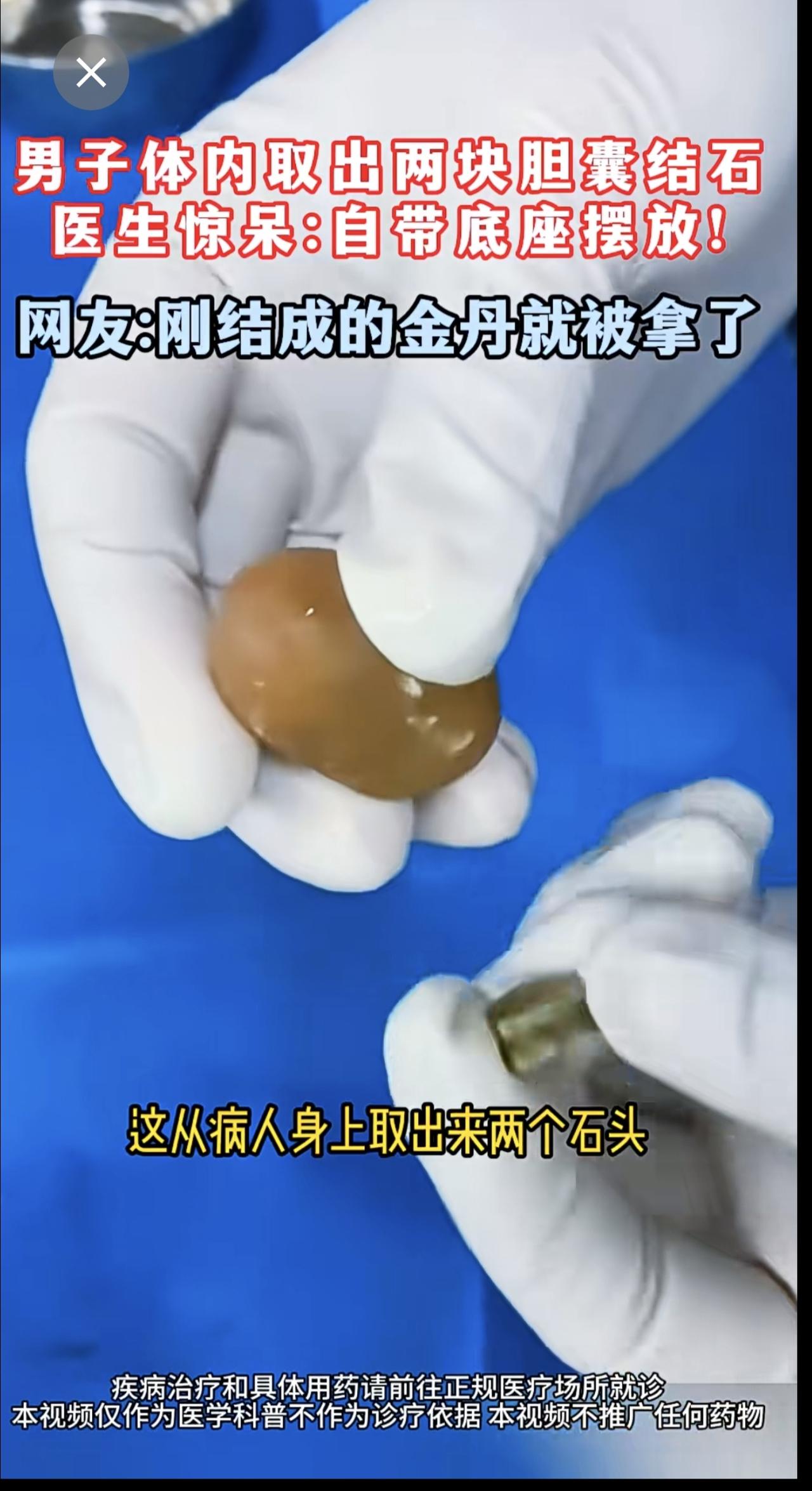 男子体内取出两块胆囊结石
医生惊呆:自带底座摆放！ 
网友:刚结成的金丹就被拿了