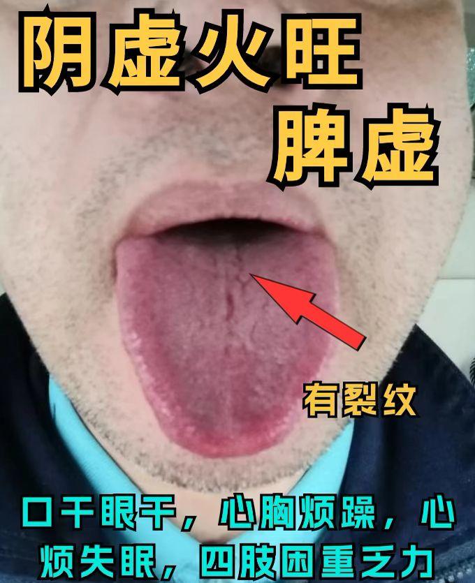 4种舌象分析 进来对照看看自己中了吗