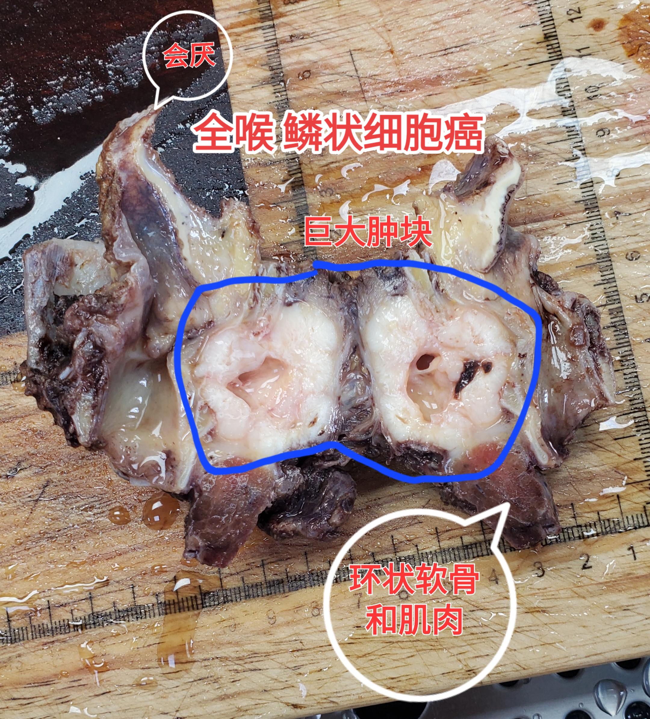 喉 鳞状细胞癌