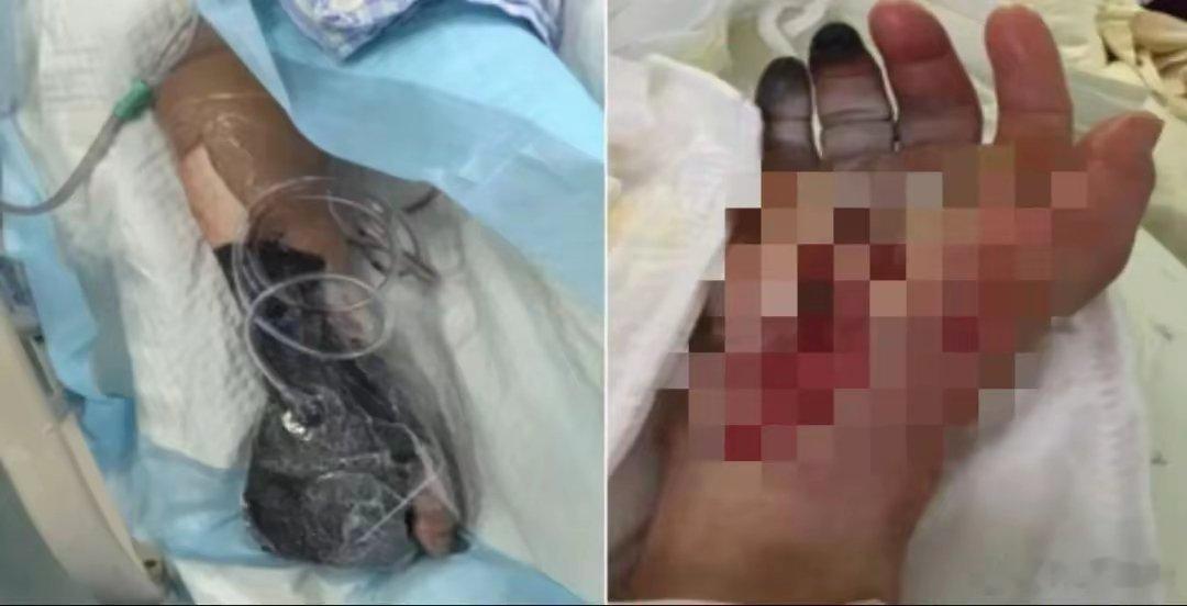 戴手套！死亡率近100%，浙江又有人中招近日，浙江绍兴一位88岁的王大爷（化名）