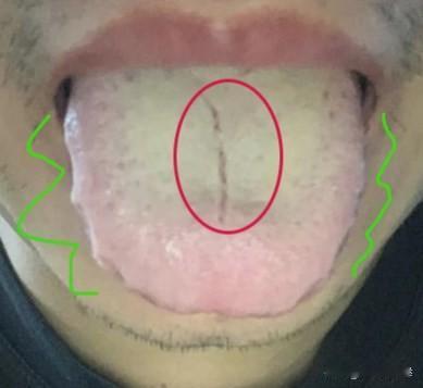 评论区舌诊实战分享：这样的舌头你要是当湿热去调理，啥时候也调不好
舌象分析：
舌