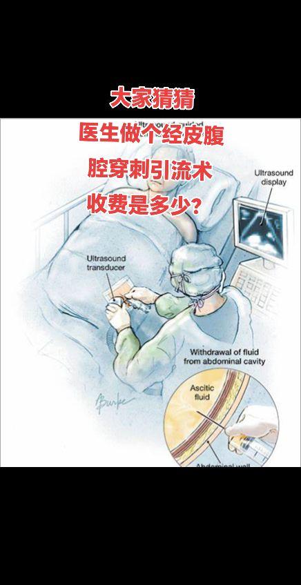 大家猜猜医生做经皮腹腔穿剌引流术收多少钱。