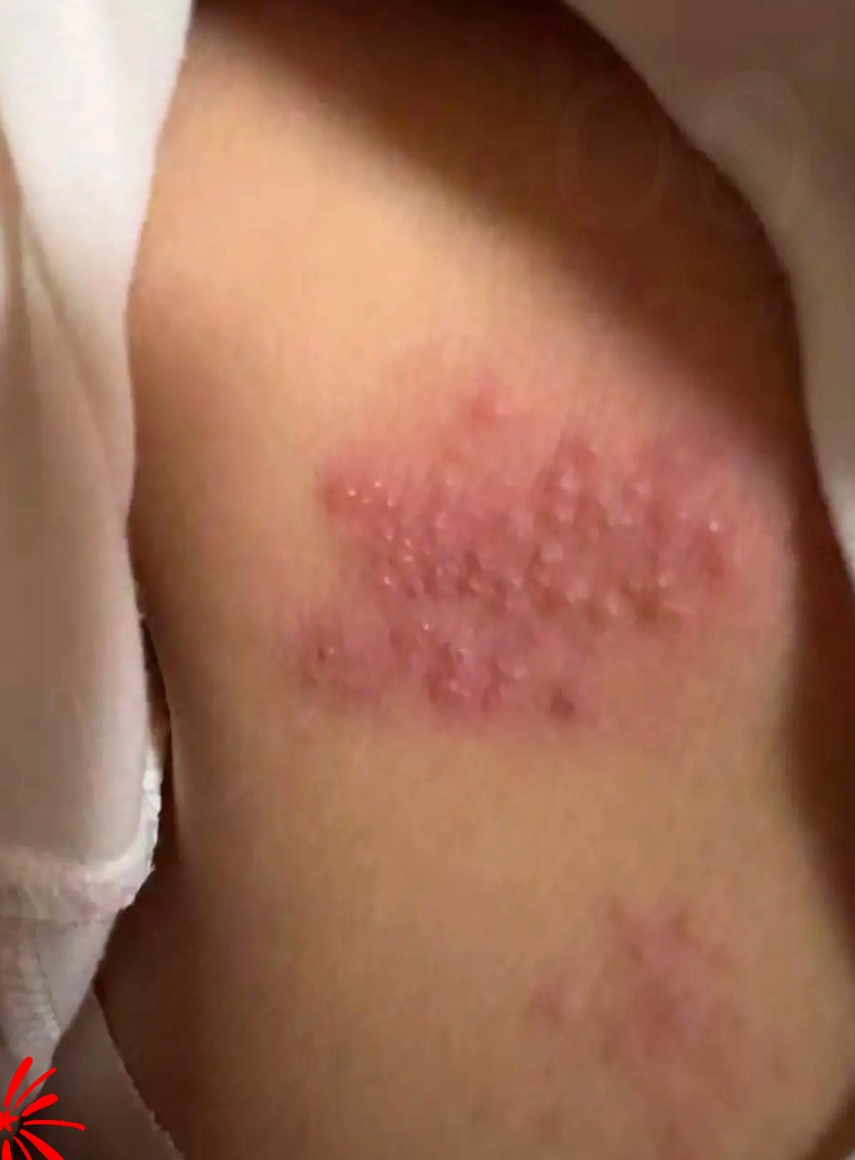 真是快被逼疯了！60岁中招蛇缠腰，一周没睡个安稳觉滋味太煎熬了！
       