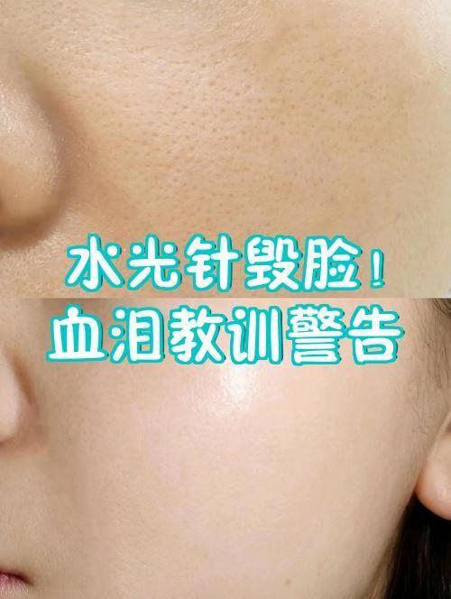 熟人一介绍，门槛就省了？“朋友介绍”的家用美容：水光针致女子面部永久凹陷

江苏