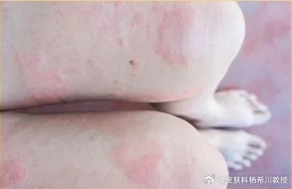 冬季冷风一吹，寒冷性荨麻疹的小伙伴又开始皮肤发痒、起风团了。提醒各位：●症状较轻