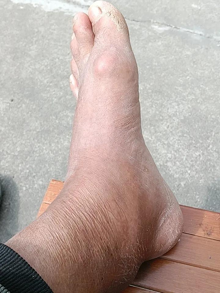 今天，我吃了一点田七粉，那个脚肿的好大