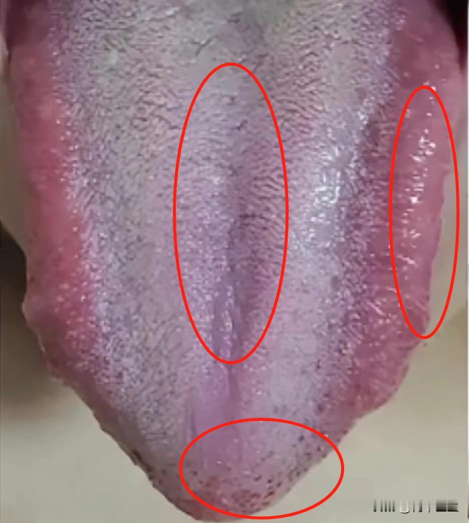 这种情况的肝郁舌头，别只会用柴胡舒肝，不仅没效果，还越来越严重

这位粉丝朋友是